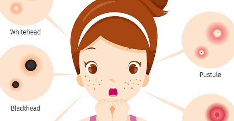 How to Get Rid of Acne with medication and more